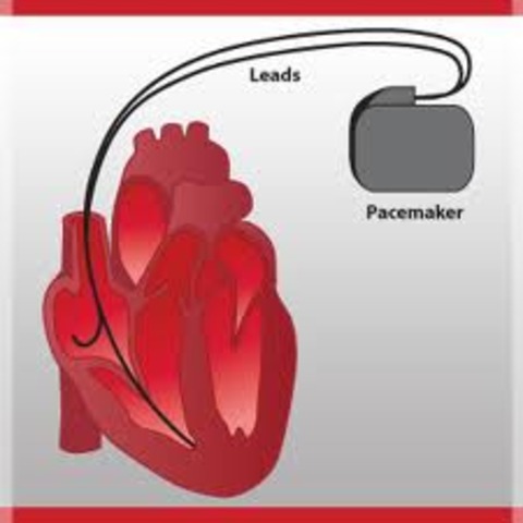 Heart Pacemaker