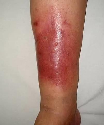 Epidemia de Erispela