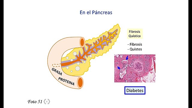 Fibrosis Quística  y Blimerasa