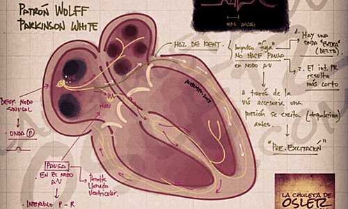 Ser detectado con el síndrome de Wolff Parkinson White