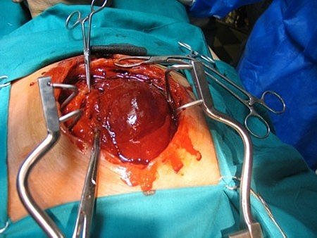 Operación de Corazon Abierto