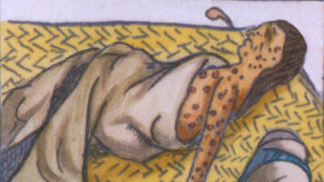 Small Pox Begins Spreading to Native Americans