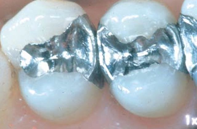 Amalgama. Implementada por los odontólogos del mundo.