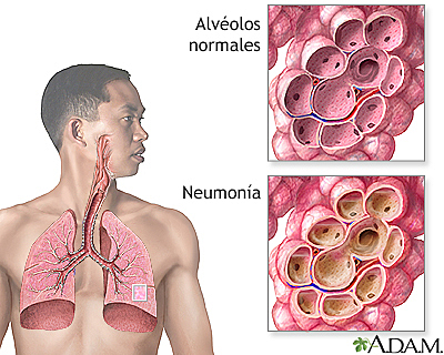 Primeros casos de coronavirus, Comienzo del covid-19 o coronavirus