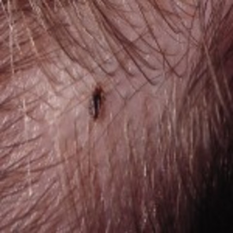 Head Lice!!