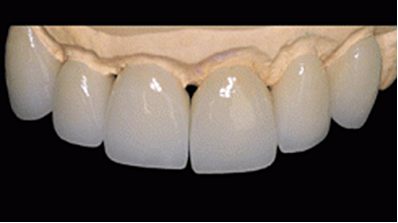 DIENTES DE PORCELANA