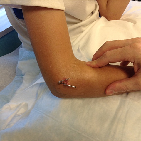 cayì y rompì mi brazo