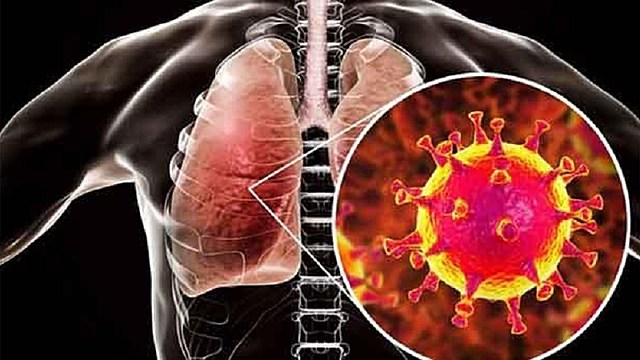 El síndrome respiratorio agudo severo