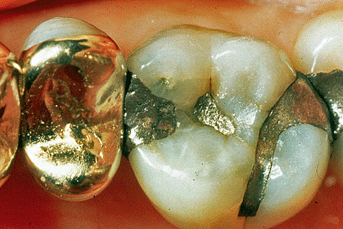 Cavidades rellenas de Oro