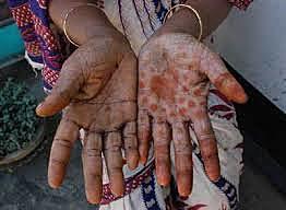 Intoxicación con Arsénico en bangladesh