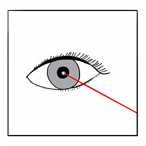 TRATAMIENTO CON LÁSER PARA LA CEGUERA POR DIABETES