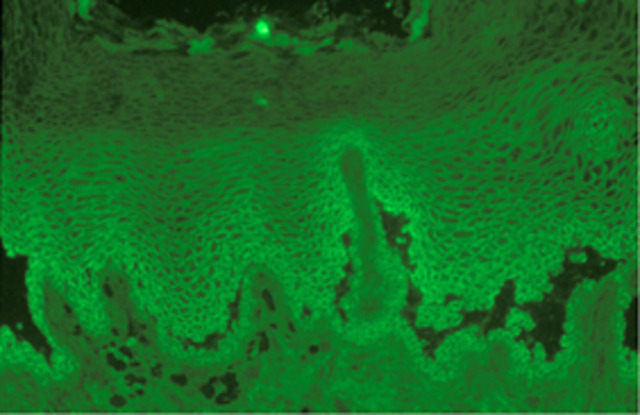 Skin Antibodies Detected in PV via IF Staining