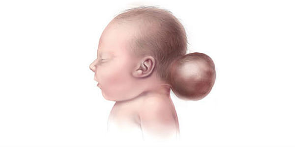 Se reporta por primera vez la recurrencia familiar de DTN sindrómicos.