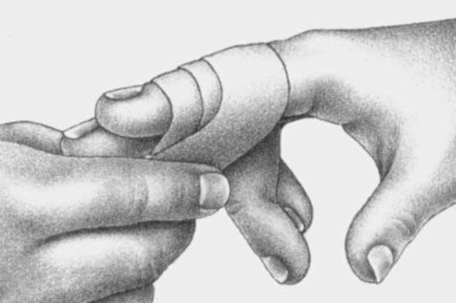 Me lastimo gravemente el dedo con una bicicleta