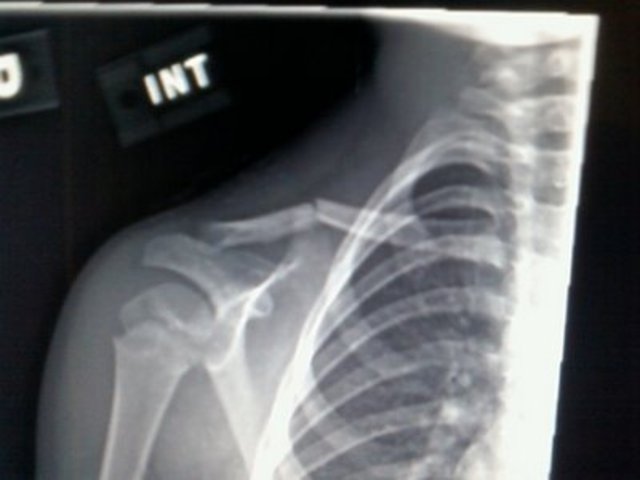 Broke My Arm