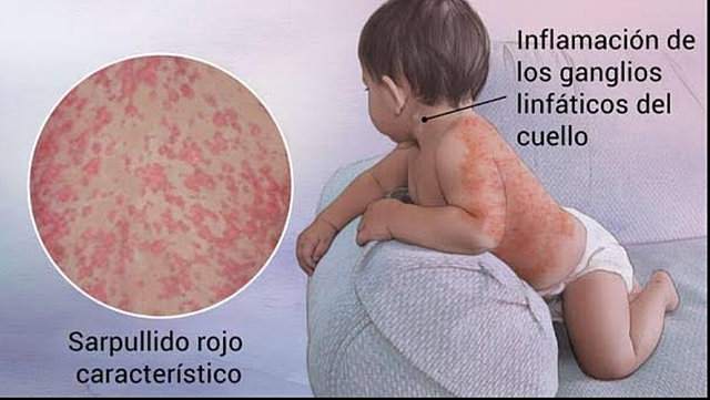 Vacuna contra la Rubeola