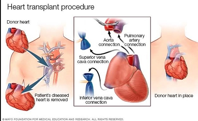 Primer Trasplante Cardíaco