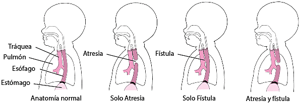 Anomalías esofágicas: