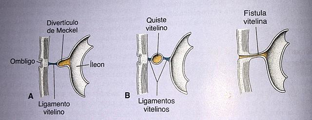Anomalía del conducto vitelino: