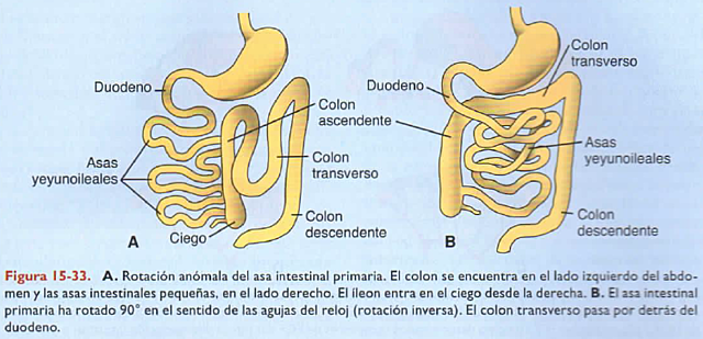 Anomalías de la rotación del intestino