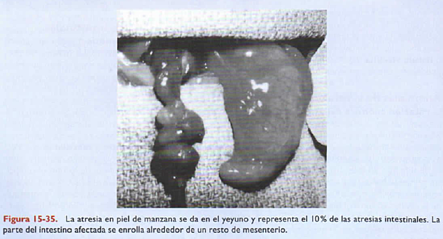 Atresia y estenosis intestinal: