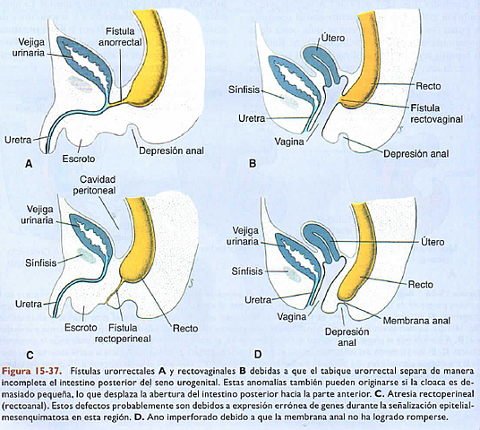 Anomalías intestino posterior:
