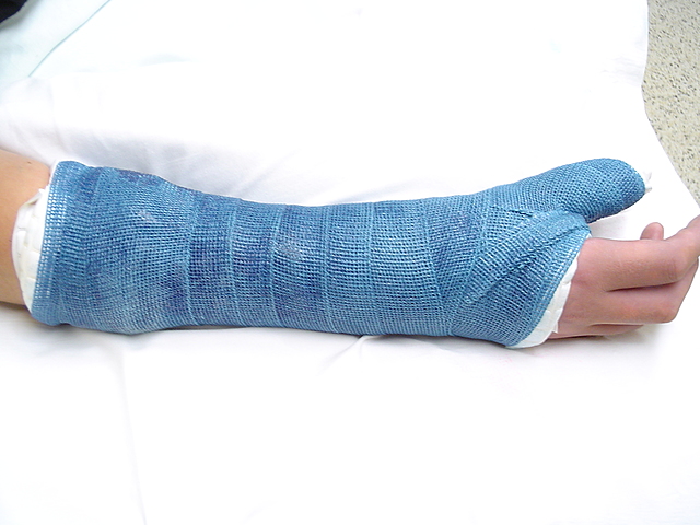 Broke my thumb again