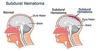 Hematoma