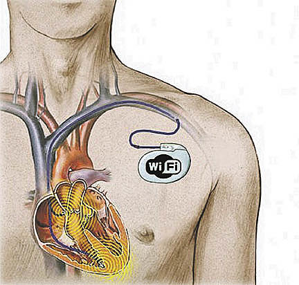SE IMPLATA EL PRIMER MARCAPASO