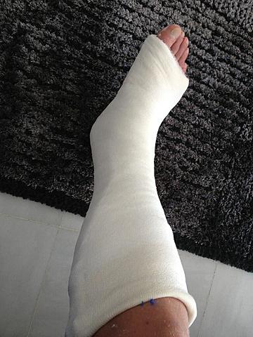 Mi primer hueso roto