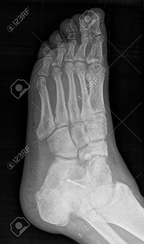 Fractura de pie izquierdo