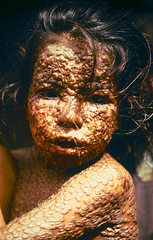 Virreinato da Nova Granada, epidemia de viruela de grandes dimensións.