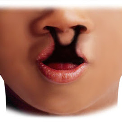 Timeline: Linea de tiempo labio leporino