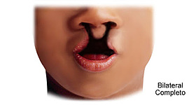 Timeline: Linea de tiempo labio leporino