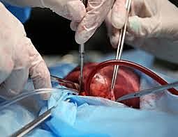 Heart Surgery