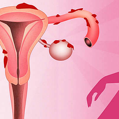 Timeline: ¿Qué es la endometrosis?