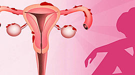 Timeline: ¿Qué es la endometrosis?