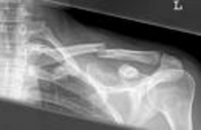 Me fracture la Clavicula