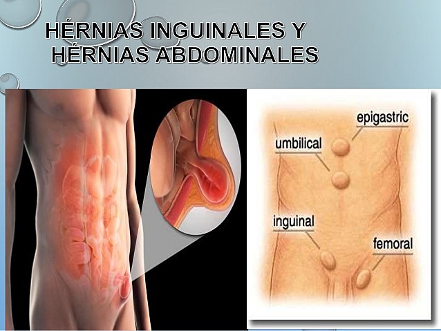 Hernias