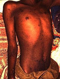 Piojos Guerreros o Tifus