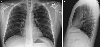 Covid-19 is Identified