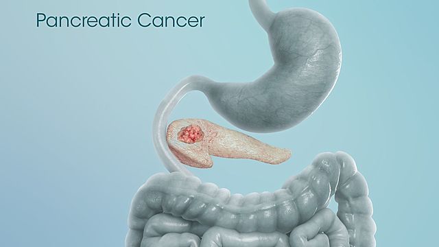 Pancreatic cancer