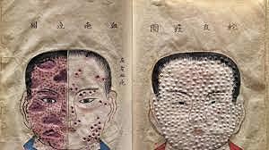 Epidemia de viruela japonesa