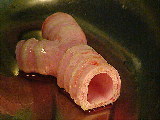 The world's first synthetic organ transplant.