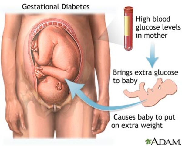 GCT/GTT at 26-28 weeks