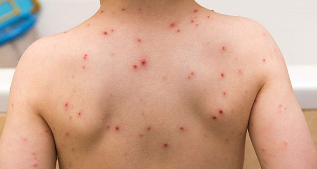 Tengo viruela junto con mi hermano