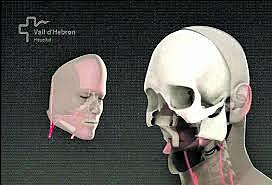 Trasplante total de cara