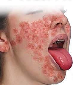 Primer brote de pelagra