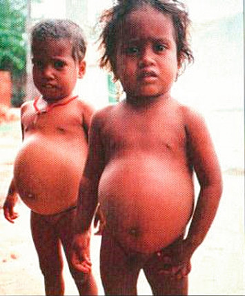 Nuevo Síndrome Kwashiorkor