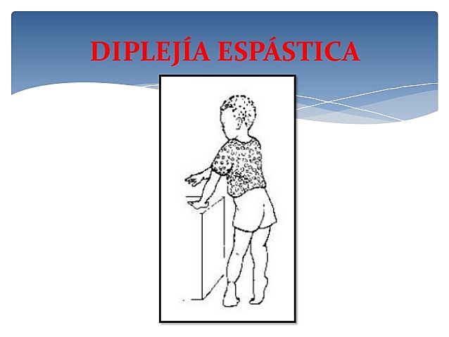 Displejía espástica